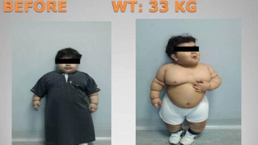 Nadwaga u dzieci Dwulatkowi zmniejszono żołądek