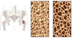 osteoporoza kosci