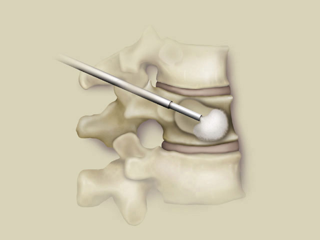 FillingCavity low