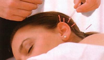 Akupunktura metoda na zdrowie!
