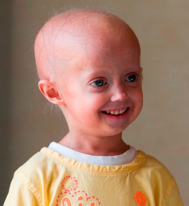 Progeria – gdy starość przychodzi za wcześnie