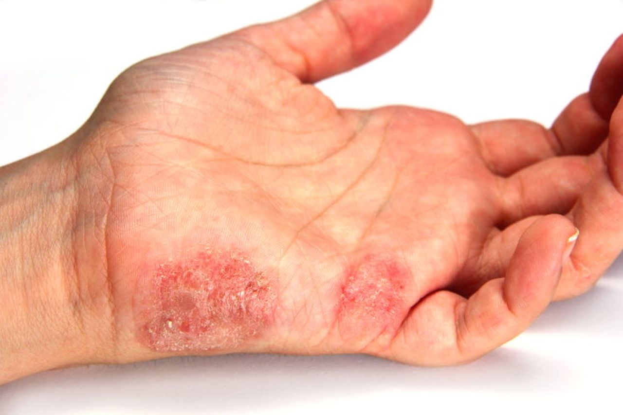 Dermatofitoza - jak walczyć z grzybicą z obręczami?